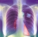 Điều trị thành công bệnh nhân ung thư phổi di căn hạch trung thất tại Trung tâm Y học hạt nhân và Ung bướu